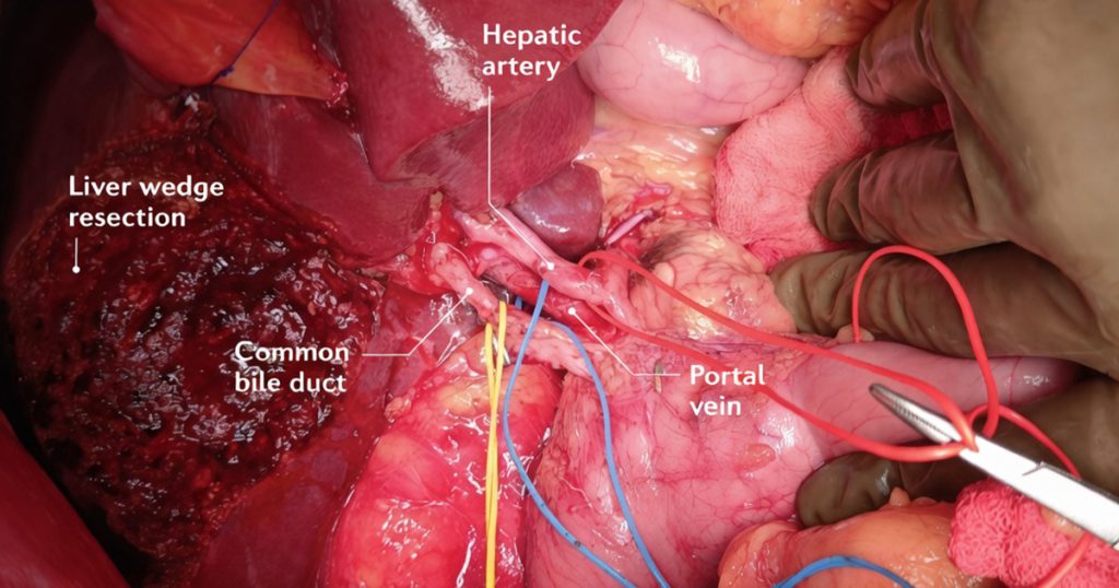 পিত্তথলির ক্যান্সার
