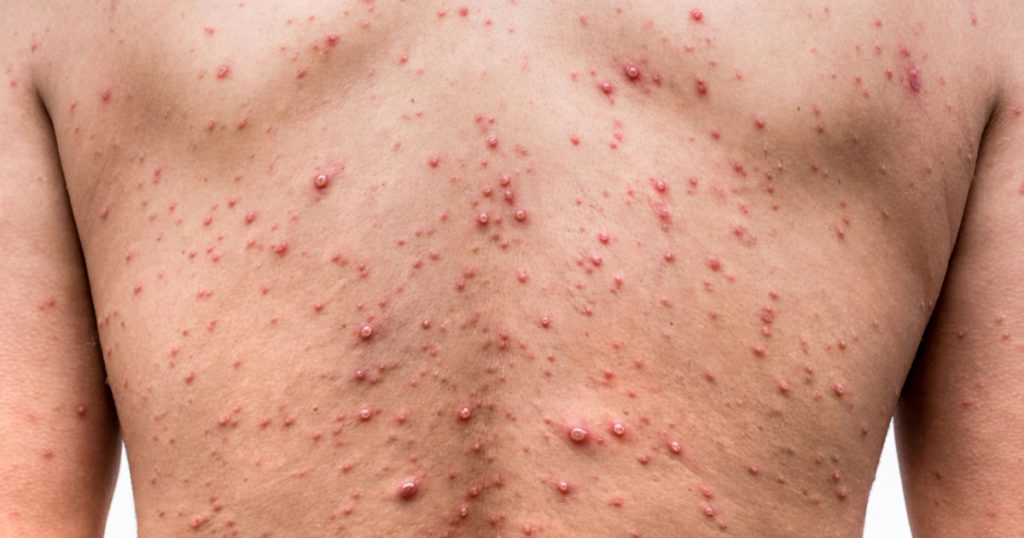 বাংলাদেশে হামের প্রকোপ ২০২৬